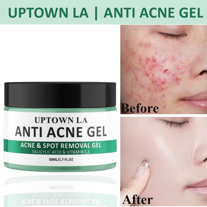 UPTOWN LA Anti Acne Gel for Acne Prone Skin and Acne Scars Marks with Niacinamide and Salicylic Acid | Anti Acne Face Treatment for Dark Spots | 50 ml 3039 Ratings